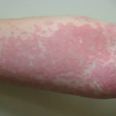 Brazo con erupción cutánea de ronchas rosadas y elevadas, algunas pequeñas y dispersas, otras formando parches más grandes.