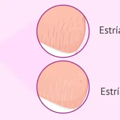 Ilustración de abdomen de embarazada mostrando estrías rojas y blancas, marcas comunes del embarazo.