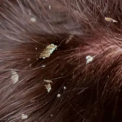 Primer plano de descamación cuero cabelludo con hebras de cabello castaño.