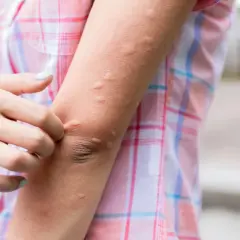 Brazo con ronchas rojas y elevadas, una mano se rasca la piel.
