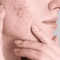 Manos tocando el rostro, mostrando marcas de espinillas y cicatrices en la piel.
