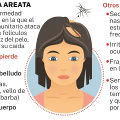 Ilustración de una mujer con alopecia areata, mostrando la pérdida de cabello en el cuero cabelludo y otros síntomas.