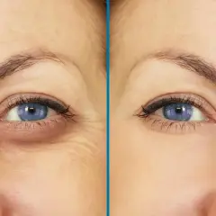 Ojos con ojeras hundidas y arrugas antes y después de un tratamiento.