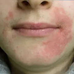 Piel enrojecida y con escamas alrededor de la boca, indicativo de dermatitis perioral. El tratamiento es clave para aliviar la irritación.