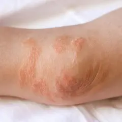 Codo con parches rojos y escamosos, indicativos de eczema. La piel está irritada y seca.