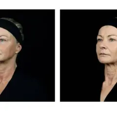 Dos retratos de perfil de una mujer mayor con banda negra, mostrando su piel.