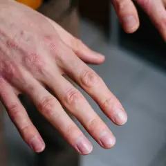 Manos con sabañones, piel enrojecida y seca en los nudillos, indicando posible irritación o frío.