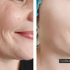 Antes y después de un tratamiento para suavizar las líneas de marioneta y rejuvenecer la piel.