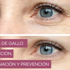 Ojos con y sin **patas de gallo**. La imagen superior muestra arrugas marcadas, mientras que la inferior, con piel más lisa, ilustra la eliminación y prevención.