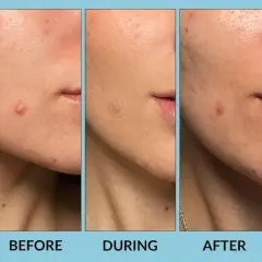 Tres imágenes de un rostro mostrando la evolución de un grano. Antes, durante con un parche de hidrocoloide, y después, con el grano reducido.
