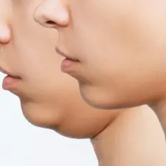 Perfil de un rostro mostrando la reducción de la papada.