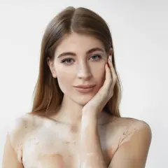 Mujer con vitiligo, su piel muestra áreas despigmentadas. El ácido salicílico para qué sirve: ayuda a exfoliar y mejorar la textura de la piel.