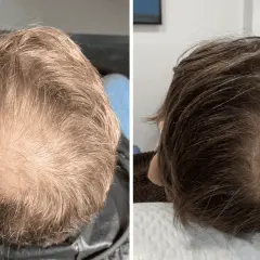 Comparación de la densidad capilar antes y después de la enzimoterapia. Se observa una mejora notable en el crecimiento del cabello.