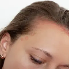 Marcas rojizas y escamas en la frente y cuero cabelludo, indicativo de dermatitis seborreica.