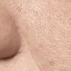Primer plano de la piel, mostrando la textura y los poros visibles. Se aprecian pequeñas imperfecciones y la delicada superficie.