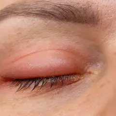 Ojo con un parpado hinchado y enrojecido, con restos de secreción amarilla en las pestañas.