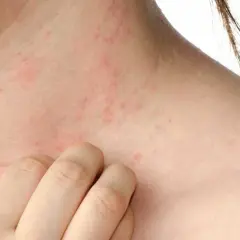 Piel irritada con enrojecimiento y pequeños bultos, indicando posible reacción a ácaros, alergia en la piel.