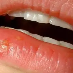 Una llaga en el labio inferior, con pequeñas ampollas y enrojecimiento.