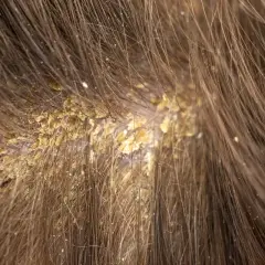 Primer plano de costras amarillentas y escamas en el cuero cabelludo, rodeadas de cabello castaño.
