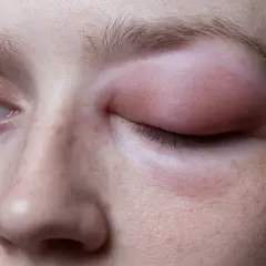 Ojo hinchado y enrojecido, con la piel irritada, como si tuviera hongos en la cara.