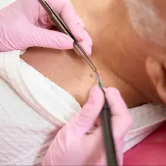 Manos enguantadas rosas realizan un procedimiento para como quitar verrugas de la piel con un instrumento de electrocauterio.