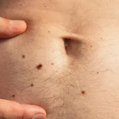 Un dedo señala la piel del abdomen, cubierta de lunares y vello. Se observa un pequeño quiste de grasa.