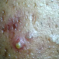 Primer plano de una pustula con pus amarillo, rodeada de piel enrojecida y vello oscuro.