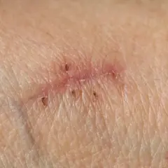 Piel con varias cicatrices, algunas con puntos de sutura visibles.