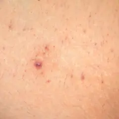 Primer plano de piel con pequeñas imperfecciones y vello fino, con una zona que recuerda a la piel de fresa.