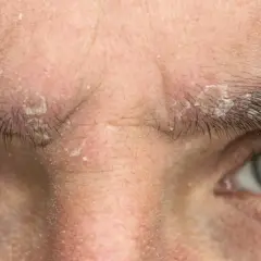 Primer plano de la frente y ojos de una persona con escamas blancas y piel irritada, indicativo de seborrea.