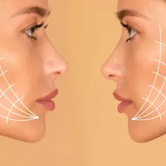 Dos perfiles de mujer con líneas blancas que simulan el efecto de un tratamiento facial. El antes y después de Thermage FLX para una piel más firme.