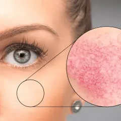 Primer plano de ojo y mejilla, con un círculo que muestra la piel con rojeces y vasos sanguíneos visibles, indicando posible demodex cara.