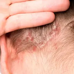 Una mano cubre parte de la cabeza, revelando un cuero cabelludo irritado con enrojecimiento y escamas blancas.