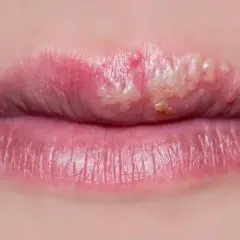 Labios con ampollas y costras, posiblemente tratables con ácido fusídico.