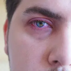 Ojo irritado con una pequeña bolita granito en la línea de agua. El párpado está enrojecido y la conjuntiva inflamada.