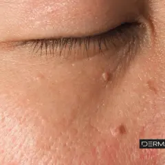 Primer plano de la piel con varias verrugas en la cara, algunas cerca del ojo.