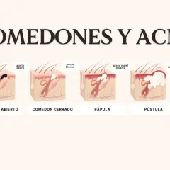 Ilustración de la piel mostrando un punto negro enquistado, un punto blanco, pápula y pústula, explicando el acné.