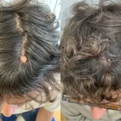 Comparación de verrugas en la cabeza antes y después del tratamiento.