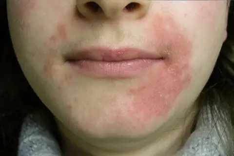 Piel enrojecida y con escamas alrededor de la boca, indicativo de dermatitis perioral. El tratamiento es clave para aliviar la irritación.
