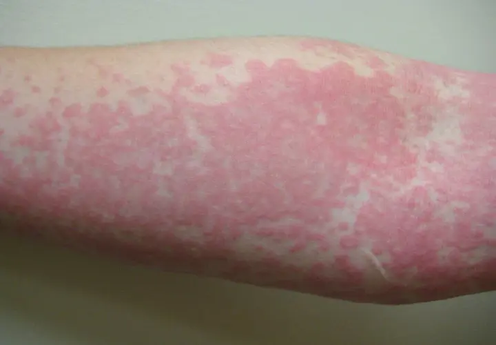 Brazo con erupción cutánea de ronchas rosadas y elevadas, algunas pequeñas y dispersas, otras formando parches más grandes.