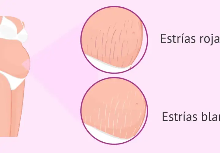 Ilustración de abdomen de embarazada mostrando estrías rojas y blancas, marcas comunes del embarazo.