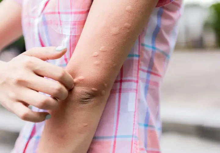 Brazo con ronchas rojas y elevadas, una mano se rasca la piel.