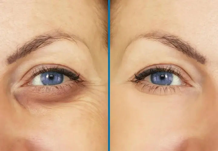 Ojos con ojeras hundidas y arrugas antes y después de un tratamiento.