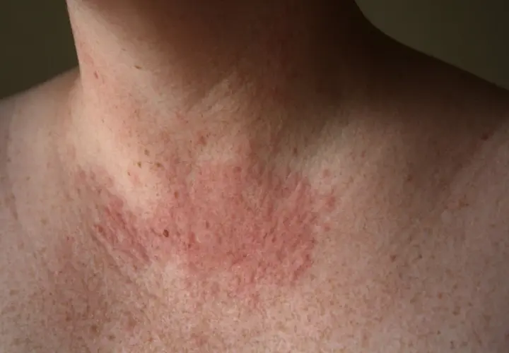 Piel enrojecida y con erupciones en el cuello y pecho, indicativo de una posible alergia al sol.
