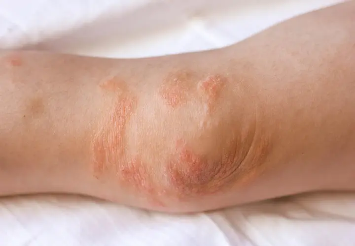 Codo con parches rojos y escamosos, indicativos de eczema. La piel está irritada y seca.