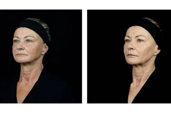Dos retratos de perfil de una mujer mayor con banda negra, mostrando su piel.