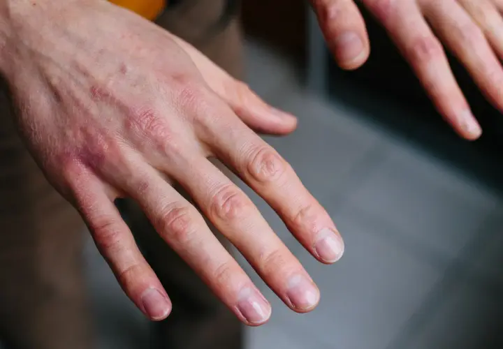 Manos con sabañones, piel enrojecida y seca en los nudillos, indicando posible irritación o frío.