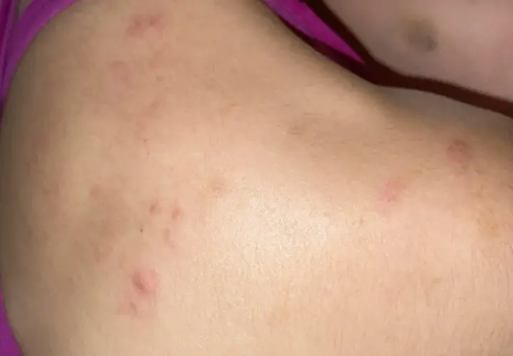 Piel con marcas rojas y elevadas, indicando posible acne en la espalda.