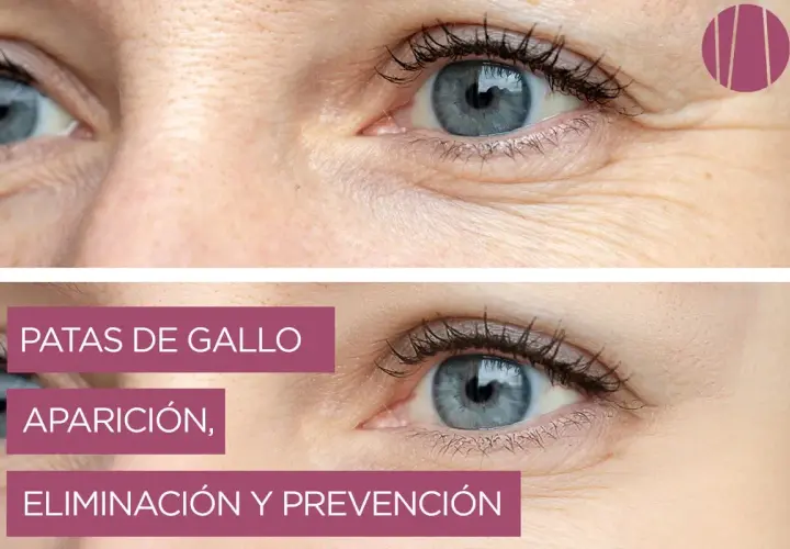 Ojos con y sin **patas de gallo**. La imagen superior muestra arrugas marcadas, mientras que la inferior, con piel más lisa, ilustra la eliminación y prevención.