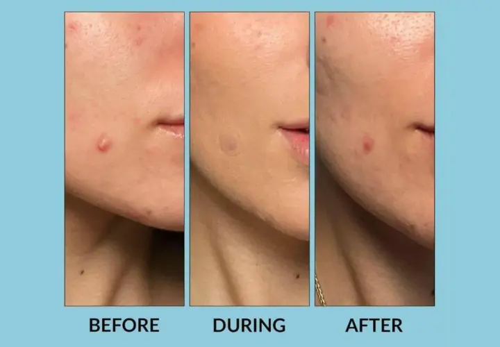 Tres imágenes de un rostro mostrando la evolución de un grano. Antes, durante con un parche de hidrocoloide, y después, con el grano reducido.